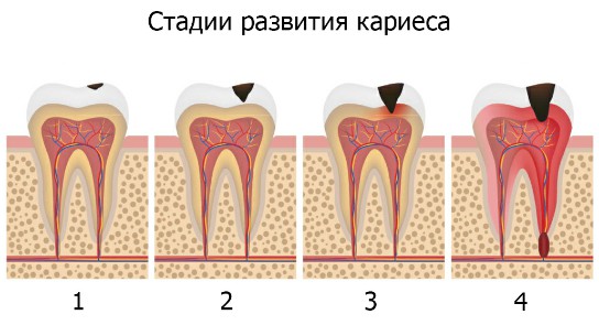 стадии кариеса