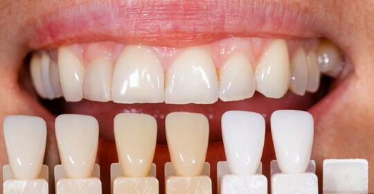 Керамические виниры